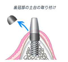 １回法 歯冠の土台を取り付け