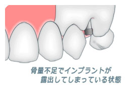 骨量が少なく露出してしまったインプラント