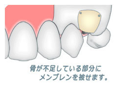 骨量が不足している部分にメンブレンを被せます