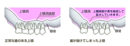 正常な歯のある上顎と歯が抜けてしまった上顎