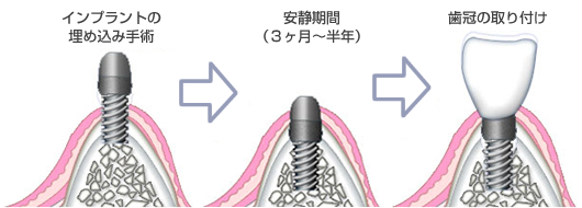 インプラント治療の流れ