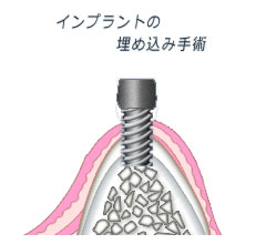 ２回法 インプラントの埋め込み