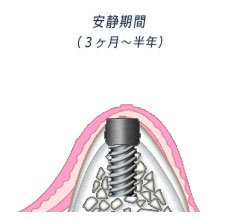 ２回法 インプラントと骨の結合