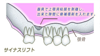 サイナスリフトを施し、骨補填剤を入れます。