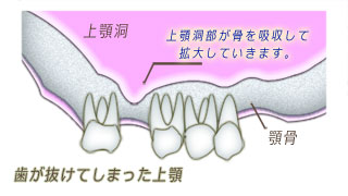 歯が抜けてしまった上顎