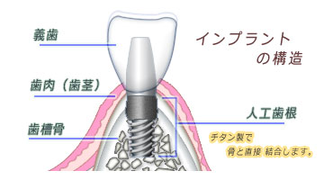 インプラントの構造