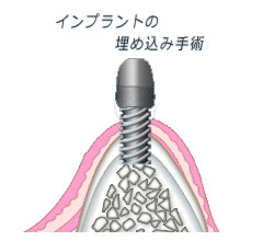 1回法 インプラントの埋め込み