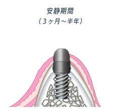 1回法 インプラントと骨の結合