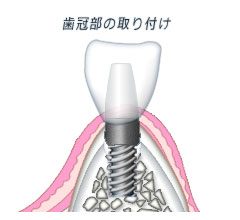 1回法 歯冠の取り付け