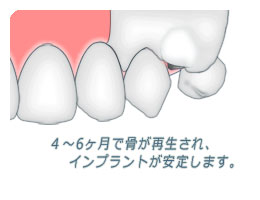 4~6ヶ月で骨が再生します。