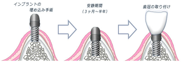 インプラント治療の流れ