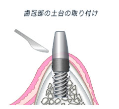 2回法 歯冠の土台を取り付け
